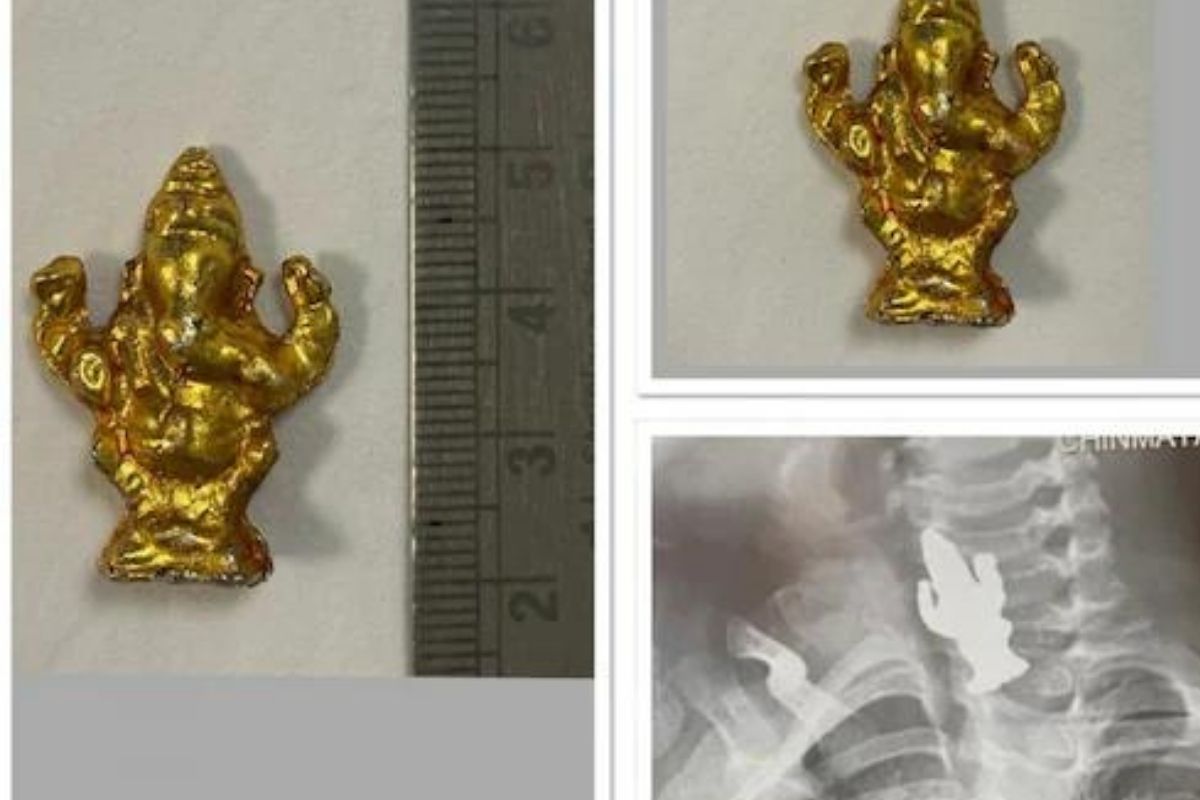 अचानक बिघडली 3 वर्षीय चिमुकल्याची तब्येत; एक्स-रे काढताच शरीरात दिसली गणेश मूर्ती