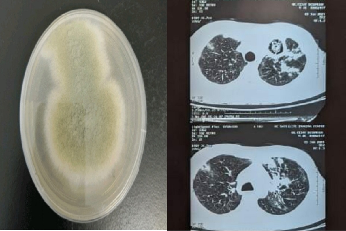 कोरोना, म्युकरमायकोसिस, बोन डेथ आणि आता ग्रीन फंगस; मुंबईवर आजारांचं संकट