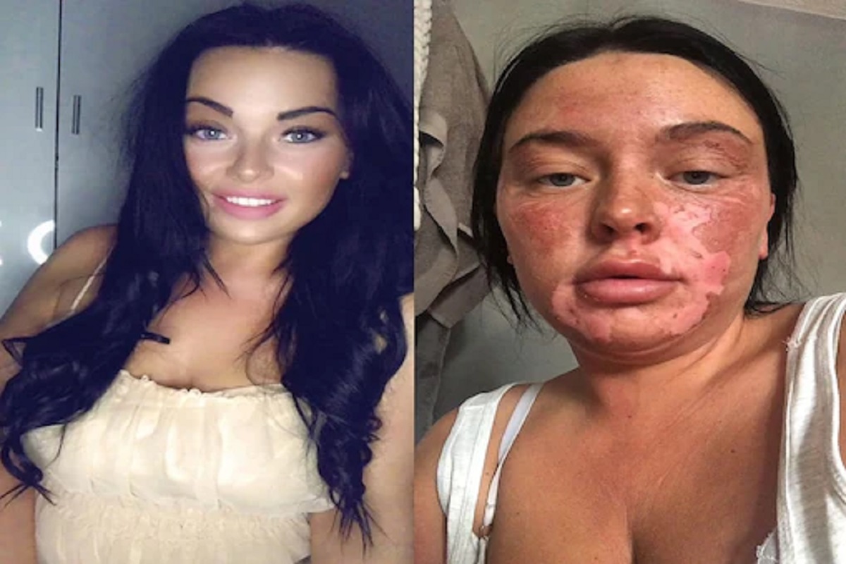 OMG! शिजवायला गेली अंडं पोळून निघाला चेहरा; ऑनलाईन रेसिपी फंडा पडला महागात