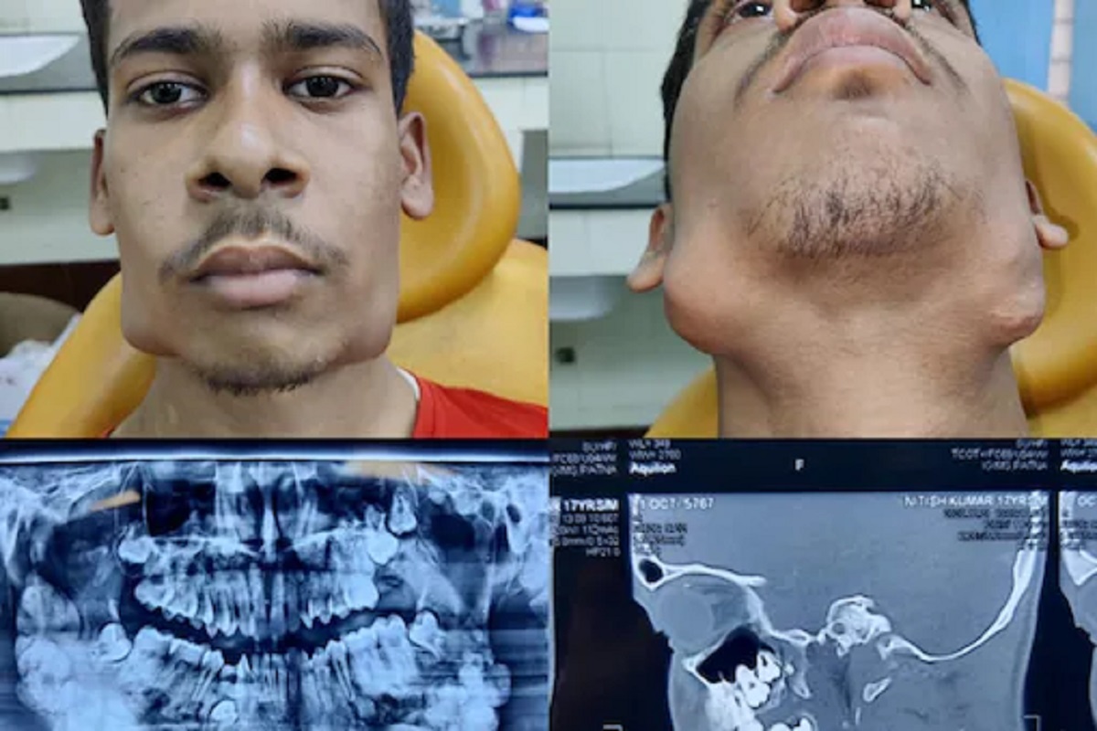 OMG! 32 नाही तर 82; 17 वर्षीय तरुणाच्या जबड्यातील दात पाहून डॉक्टरही शॉक