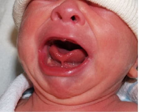 तुमचं बाळ अजूनही बोलत नाही? Tongue Tie असू शकतं कारण