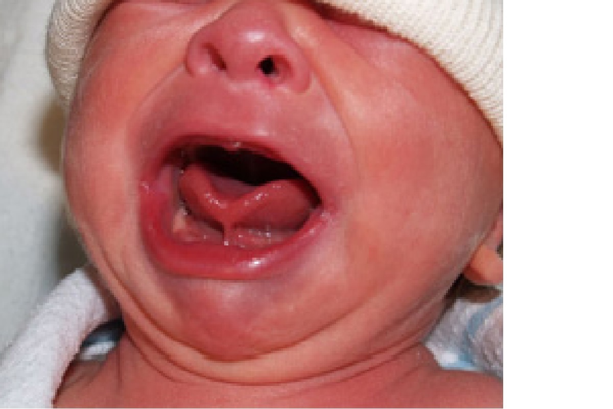 तुमचं बाळ अजूनही बोलत नाही? Tongue Tie असू शकतं कारण