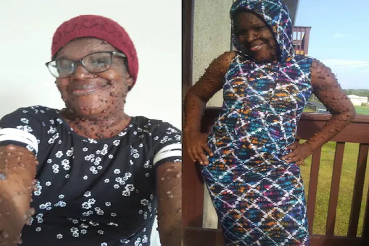 OMG! शरीरावर अशी एकही जागा नाही जिथं गाठ नाही; या महिलेला नेमकं झालंय तरी काय?