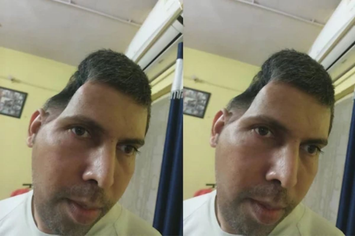 OMG! असा कसा डॉक्टर, ऑपरेशननंतर हाड गायब; आता अर्धवट डोकं घेऊ फिरतेय व्यक्ती