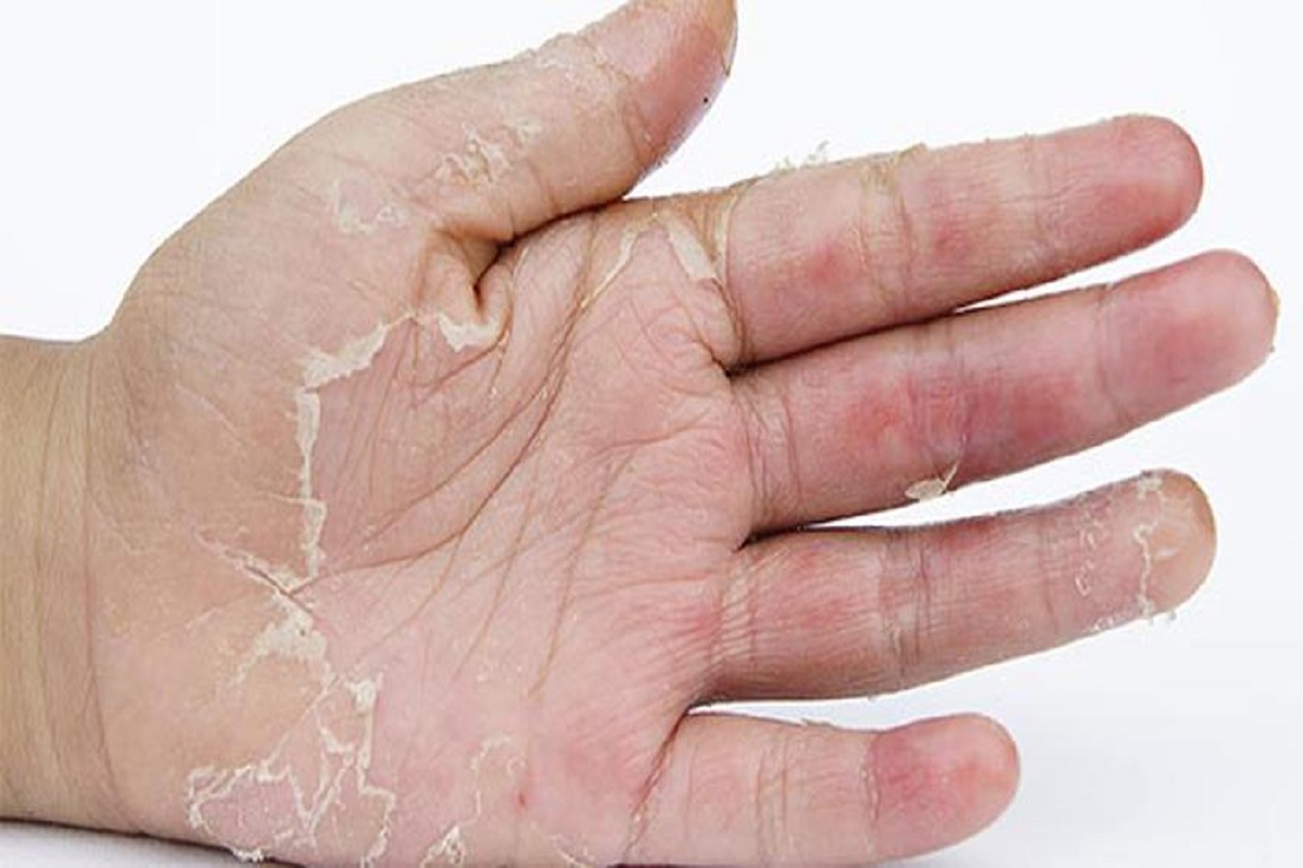 त्वचा निघत असेल तर, क्लिन्जर लावायला हवं.