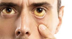 कावीळ झाली असेल तर, कच्चे शिंगाडे खावेत.