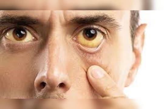 कावीळ झाली असेल तर, कच्चे शिंगाडे खावेत. 