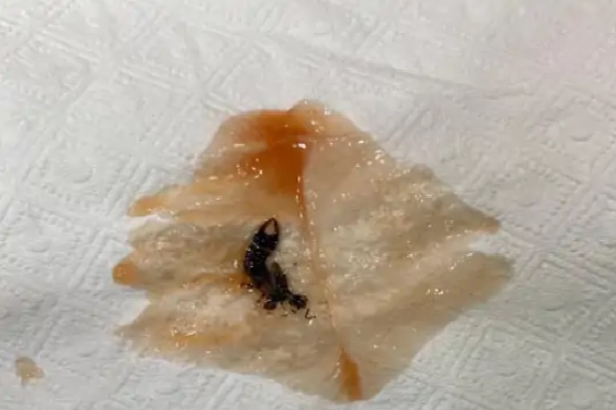 बापरे! हॉटेलमधील बर्गरमध्ये होता विंचू, पहिला घास खाताच तरुण हॉस्पिटलमध्ये दाखल