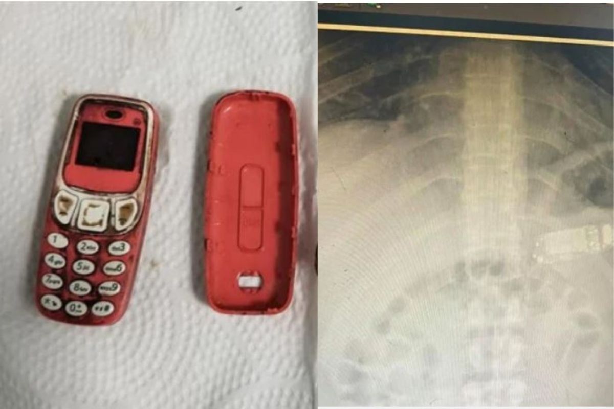 बापरे! युवकानं पूर्ण Nokia 3310 फोनच गिळला; स्कॅनमध्ये पोटात जे दिसलं ते पाहून डॉक्टरही हादरले