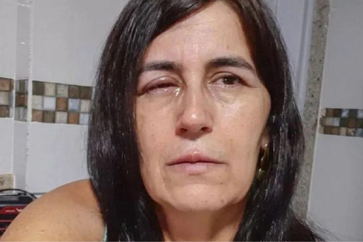 धक्कादायक! ...म्हणून बॉयफ्रेंडनं डोळ्यात टाकला Glue; भयंकर झाली तरुणीची अवस्था