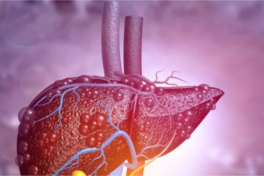 Health Tips : आहारात तुम्ही 'हे' अन्नपदार्थ खात असाल तर आहे लिव्हरला आहे धोका