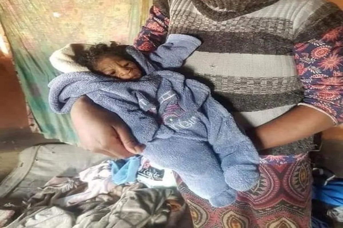 OMG! जन्मतःच गोंडस बाळ झालं म्हातारं; चिमुकल्या लेकीचं रूप पाहून आईसुद्धा शॉक