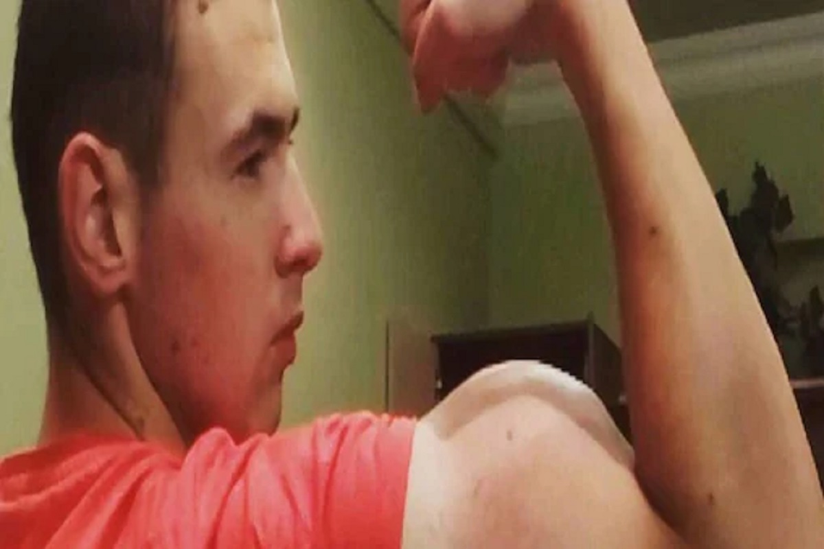 ढोलेशोले बनवण्यासाठी घेतलं 6 लीटर पेट्रोलिअम जेलीचं इंजेक्शन; आता जीवासाठी धडपडतोय बॉडीबिल्डर