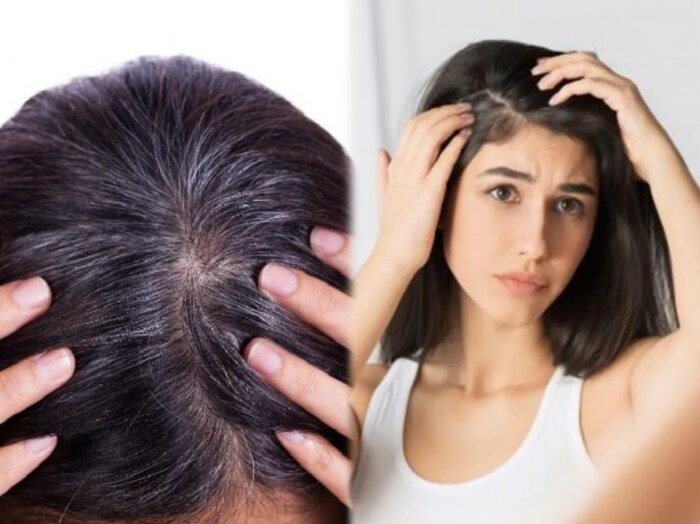 त्यामुळे केस हळूहळू पांढरे होणे हे शरीरातील अशक्तपणाचे एक उदाहरण आहे. आणि यामुळे वयाच्या अगदी कमी वर्षी आपले केस पांढरे होऊ लागतील. आणि आपण लवकरच म्हातारे दिसायला लागू. त्यामुळे जर आपण सतत विचार करत असू, इतर ताणतणाव, किंवा आपल्याला मोठा आजार असेल, तर आधी आपण आपल्या जीवनशैलीत बदल केला पाहिजे. आणि आपल्या शरीराकडे लक्ष दिल पाहिजे. 