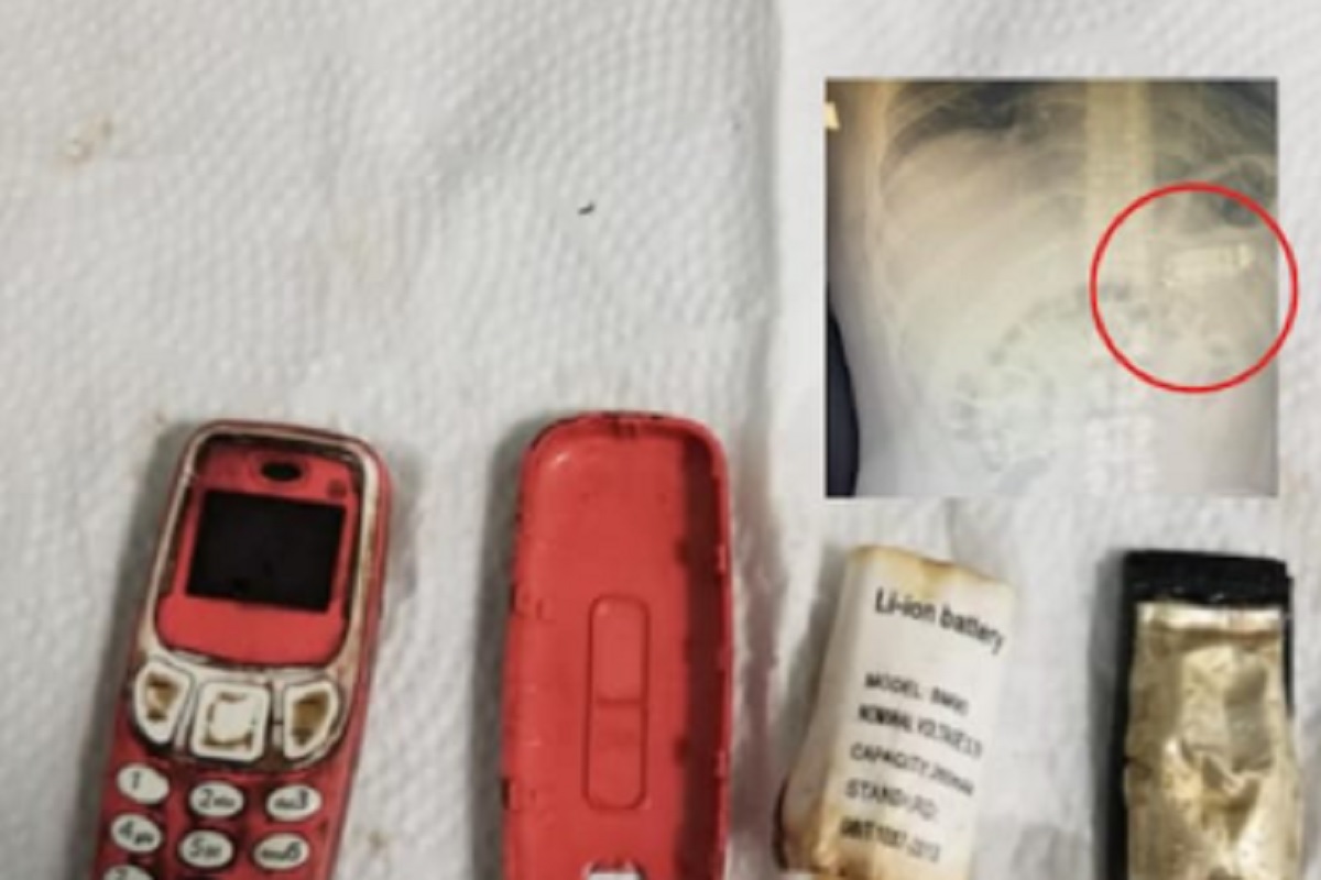 बापरे हे काय विचित्र! व्यक्तीने गिळला अख्खा Nokia 3310 मोबाईल, पोटात झाले तीन तुकडे, X-Ray पाहून डॉक्टरही शॉक