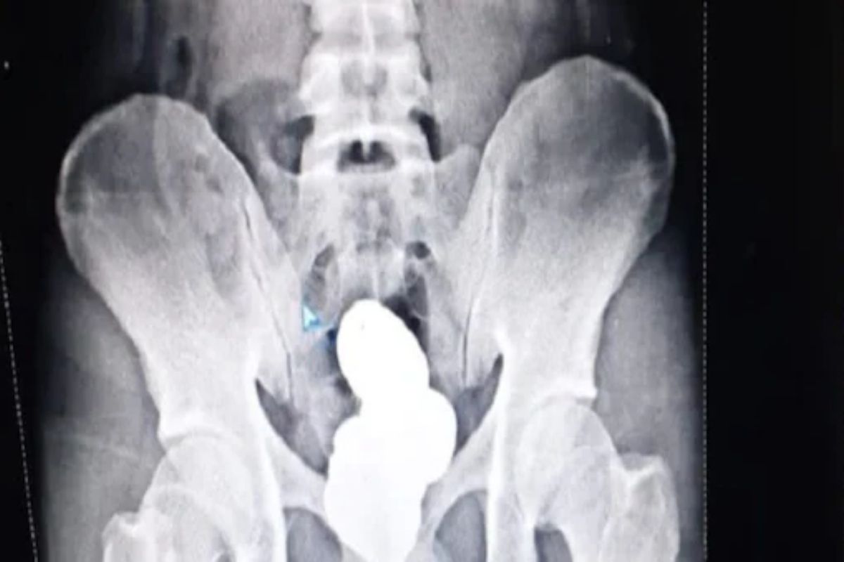 व्यक्तीच्या पोटाची किंमत 42 लाख! अशी लपवली होतील सोन्याची बिस्कीटं की पाहून धक्काच बसेल!