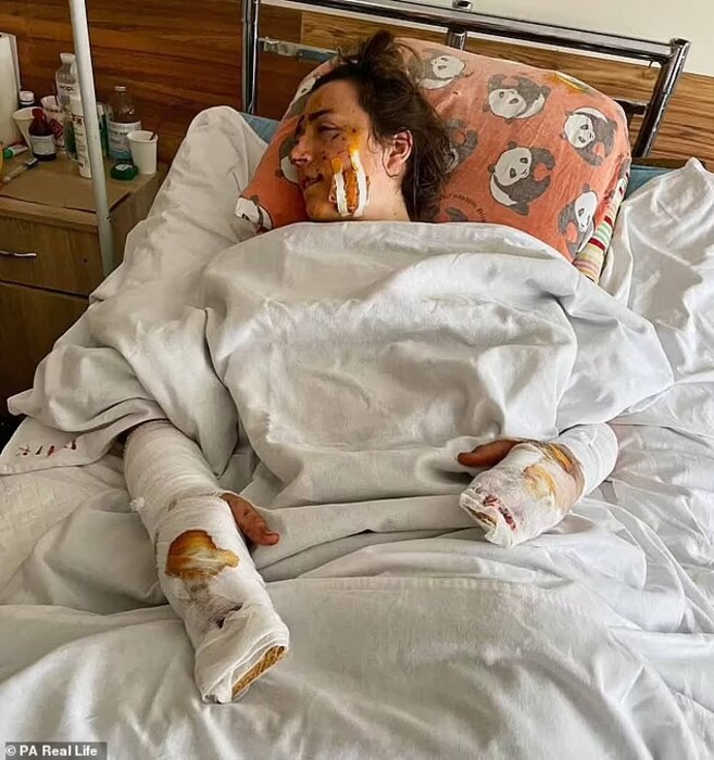 लिडिया आणि नॉर्बर्ट हे आपला हनीमून साजरा करण्यासाठी यूक्रेनला गेले होते. त्यावेळी त्यांच्याबरोबर काही मित्रदेखील होते. हे सगळे लोक रात्री पार्टी करत असताना अचानक जमिनीखालून एक मोठी बॉम्बस्फोट झाला. त्यात हे कपल जखमी झालं आहे.