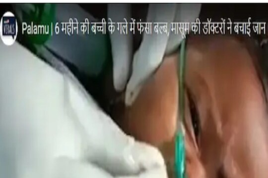 बिचारं! बाळाने गिळला बल्ब, एका निर्णयामुळे वाचला जीव; पाहा VIDEO