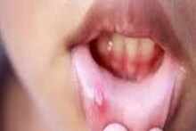 Mouth Ulcers Treatment : तोंडातील अल्सर घालवण्यासाठी हे घरगुती उपाय आहेत गुणकारी