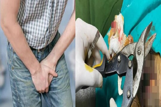 बापरे! 2 महिने बाटलीत अडकला त्याचा Private part; अवस्था पाहून डॉक्टरांनी कापूनच टाकला