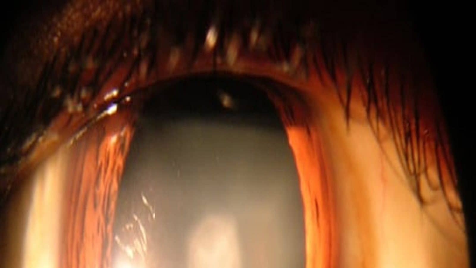 Pellet injected into eye implant for cataracts treatment without