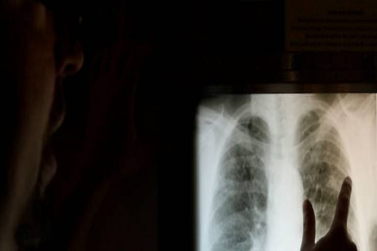 Alert! कोरोनानंतर भारतात पहिल्यांदाच Drug resistant Fungus चा शिरकाव; दोघांचा मृत्यू