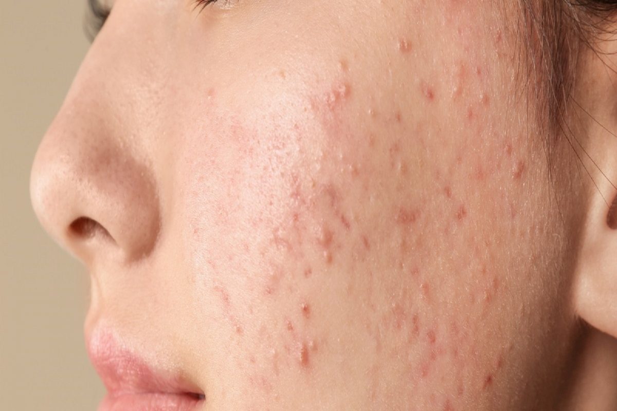 Skin Care : रात्री झोपण्यापूर्वी या गोष्टी करण्यास विसरू नका; पिंपल्स होतील लगेच कमी