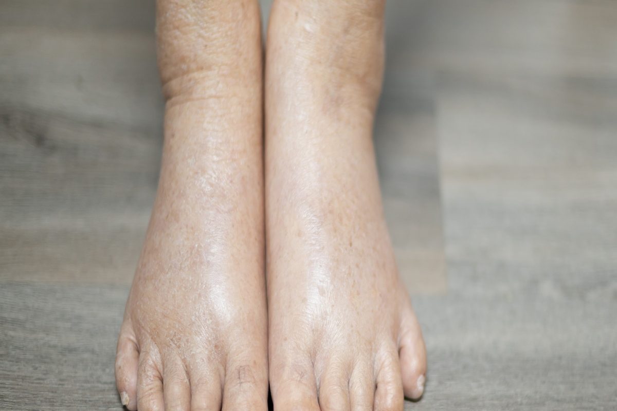 Swollen feet : थंडीच्या दिवसात तुमचेही पाय सुजतात का? हे घरगुती उपाय करून पाहा परिणाम