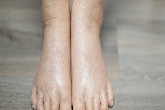 Swollen feet : थंडीच्या दिवसात तुमचेही पाय सुजतात का? हे घरगुती उपाय करून पाहा परिणाम