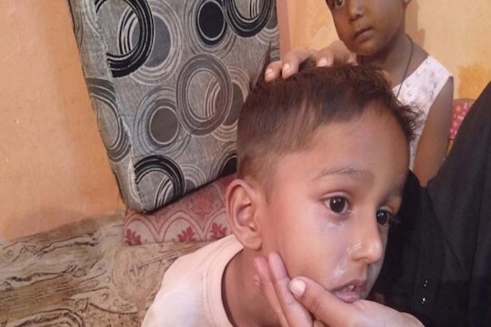  एक दुचाकीवर आलेल्या तरुणाने 5 वर्षांच्या मुलाच्या चेहऱ्यावर ज्वलनशील द्रव्याने हल्ला केला.