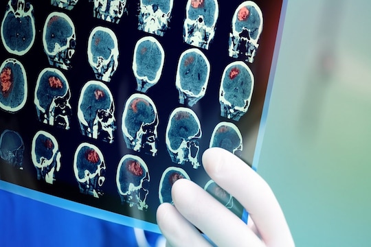 ब्रेन स्ट्रोक आलेल्या व्यक्तीला समजदार व्यक्ती वाचवू शकतो; ही लक्षणं दिसली की ताबडतोब गाठा हॉस्पिटल