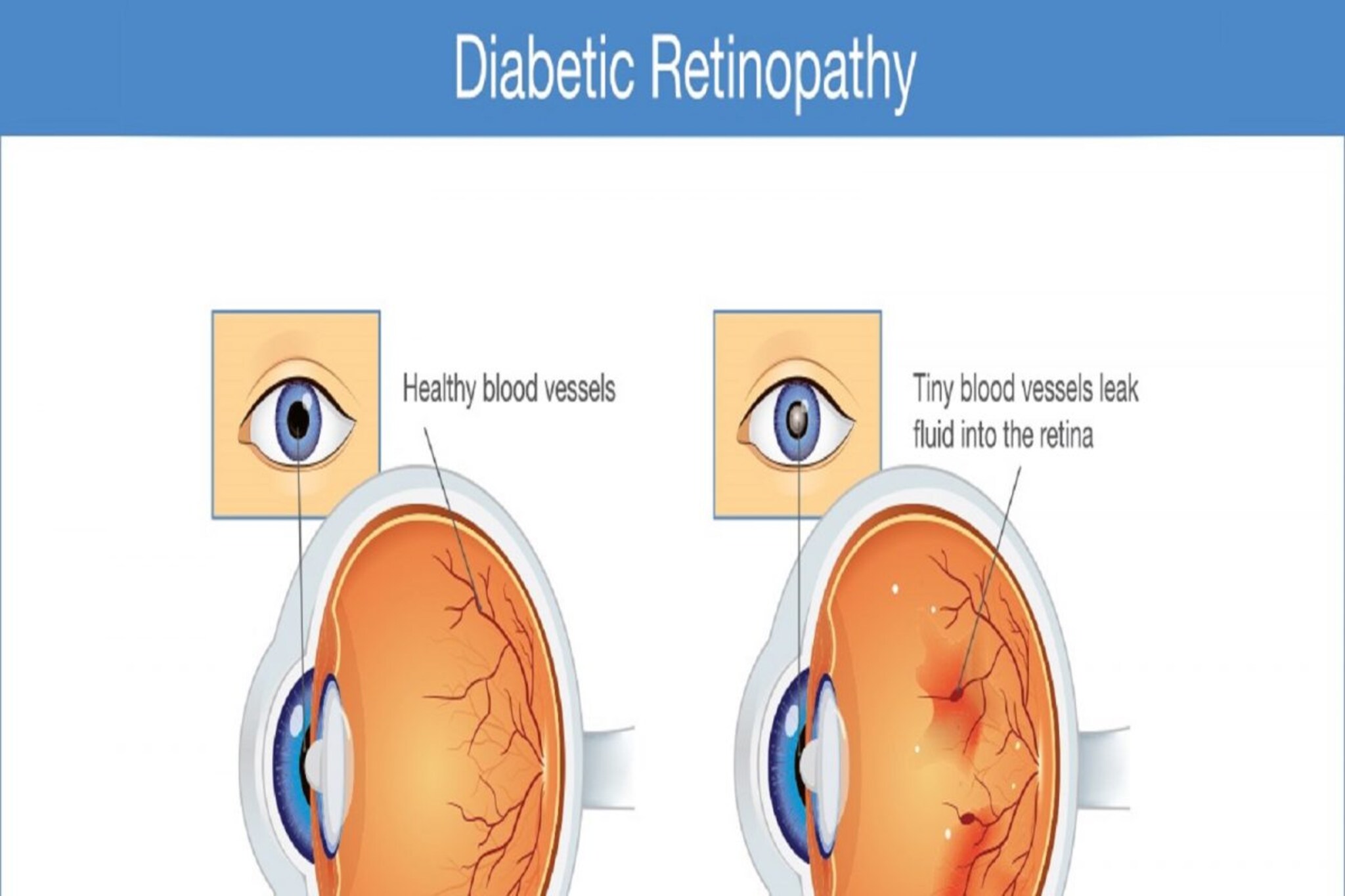 जर तुम्ही मधुमेहासोबत जगत असाल तर डोळ्यांचा बिघाड ज्याबद्दल माहिती आवश्यक आहे