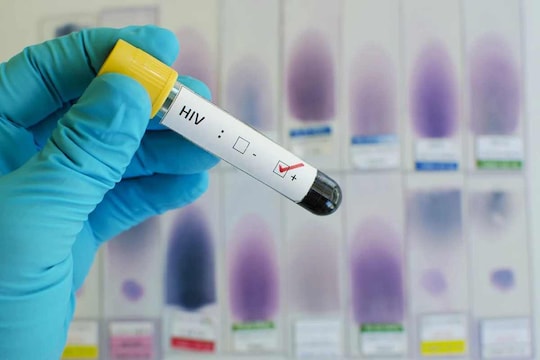 HIV Prevention: 10 वर्षात लाखों भारतीय झालेत HIV पॉजिटिव, बचावासाठी या टिप्स नेहमी ध्यानात ठेवा