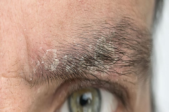 Eyebrow Dandruff: तुमच्या भुवयांमध्येही होतोय कोंडा? काळजी करू नका त्यावरही आहेत घरगुती उपाय