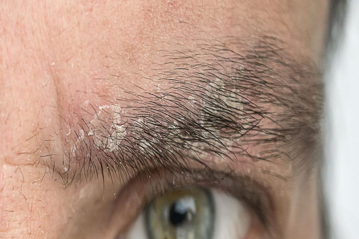 Eyebrow Dandruff: तुमच्या भुवयांमध्येही होतोय कोंडा? काळजी करू नका त्यावरही आहेत घरगुती उपाय