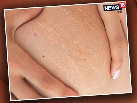 Stretch Marks Removal Tips: अनेक लोकांच्या शरीरावर वजन वाढल्यानंतर, कमी केल्यानंतर पोट, हात आणि मांड्या यांसारख्या ठिकाणी रेषा पडलेल्या दिसू लागतात. बहुतेक वेळा कोणत्याही वयोगटातील लोकांमध्ये असं होऊ शकतं. 