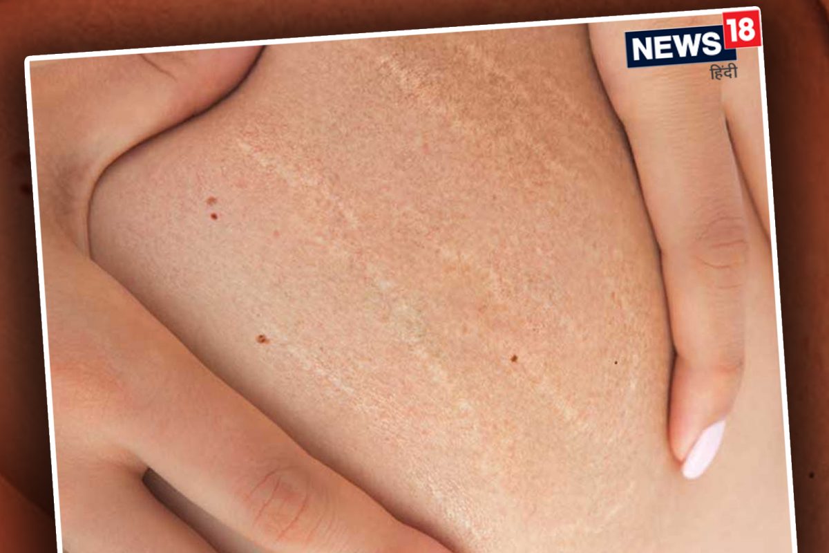 Stretch Marks Removal Tips: तुमच्याही बॉडीवर येताहेत का स्ट्रेच मार्क्स; हे घरगुती उपाय आहेत त्यावर फायदेशीर