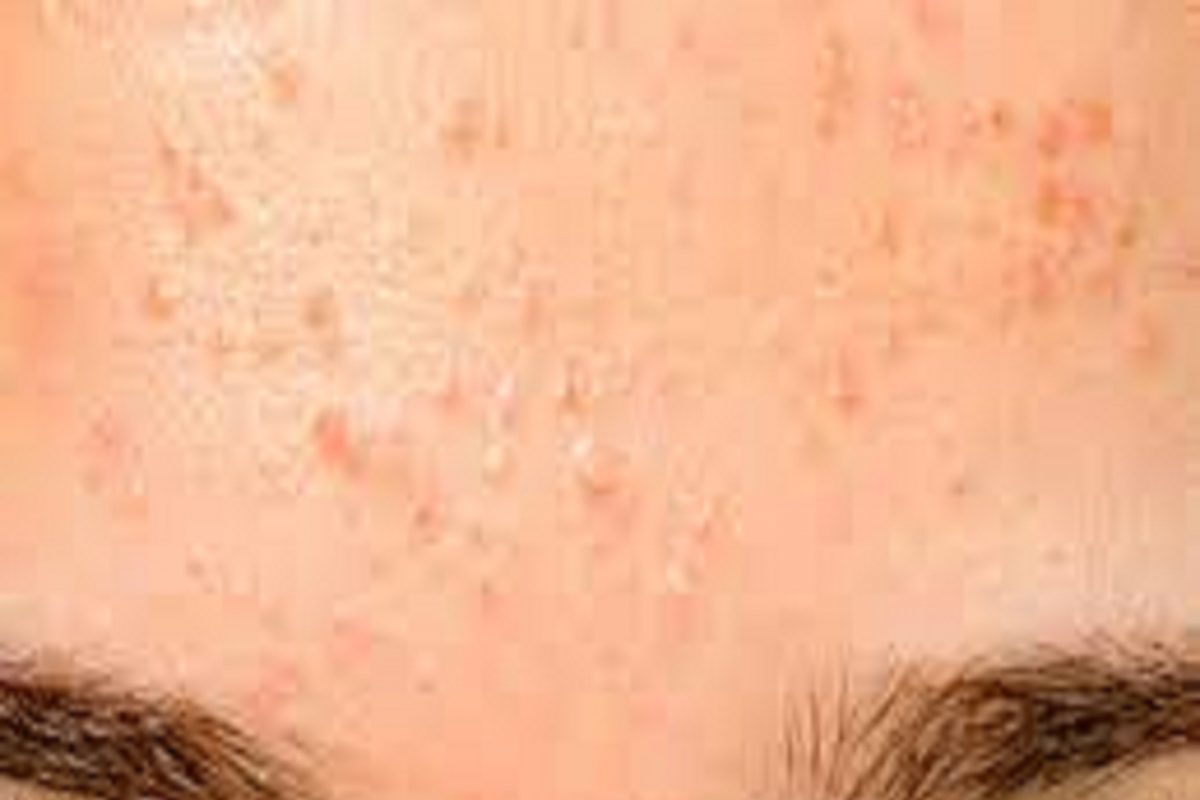 Forehead pimples: कपाळावरील पिंपल्स घालवण्यासाठी हे उपाय करून पाहा; घरच्या-घरी दिसेल जबरदस्त परिणाम