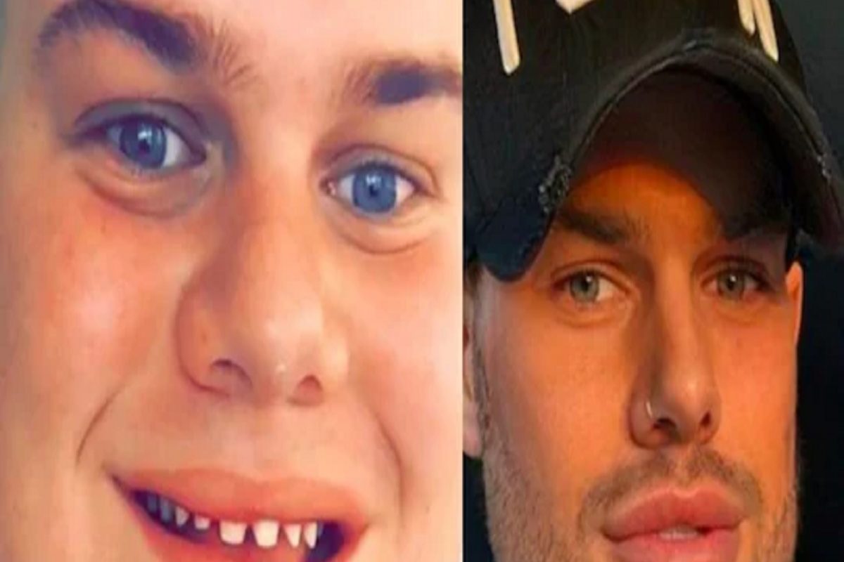 Social media वरील उपाय पडला महागात! 21 लाख रुपये खर्चून तरुणाने शरीराची लावली वाट