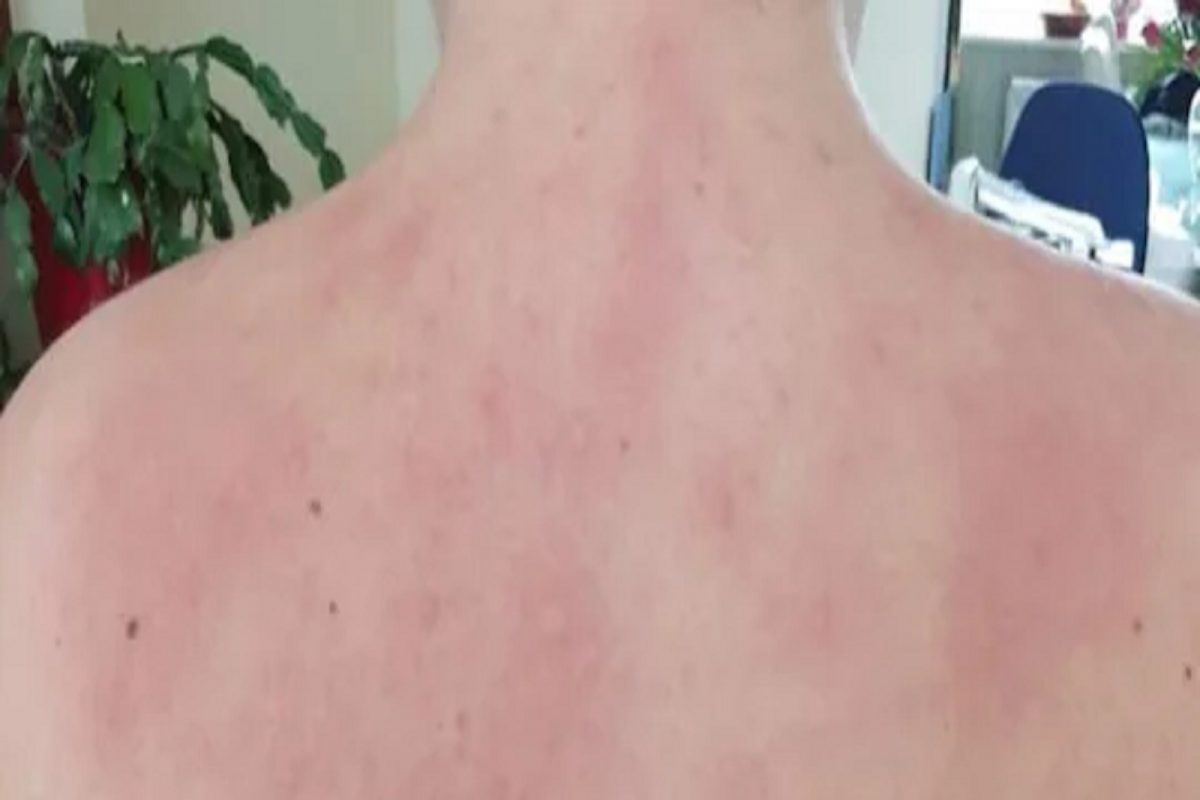 बापरे! पाण्याचा थेंब जरी शरीरावर पडला तरी जळते तरुणीची त्वचा; घाम आणि अश्रूंपासूनही धोका