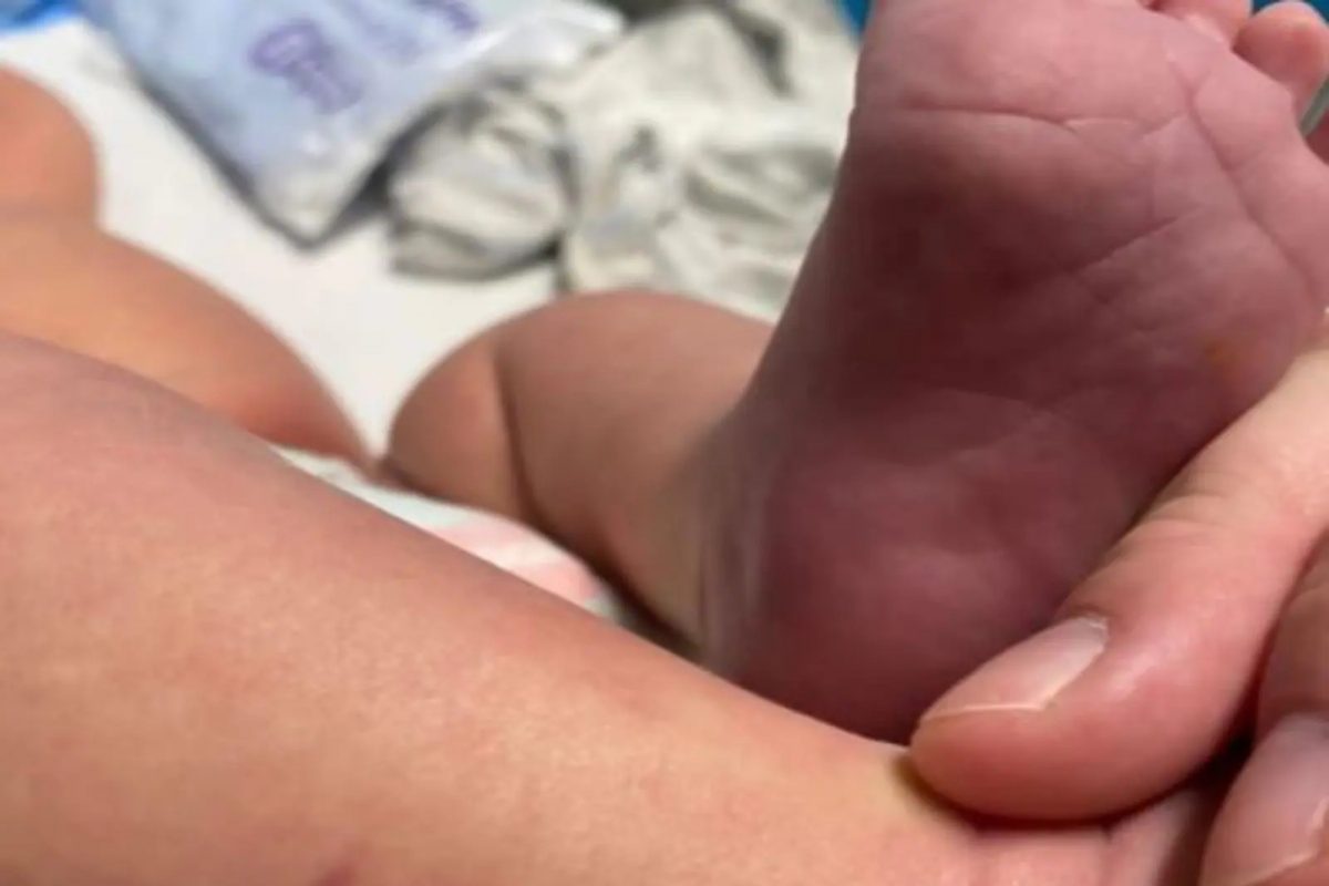 बाळाच्या शरीरावर दिसल्या 'जीवघेण्या खुणा', डॉक्टरचं निदान ऐकून बसला धक्का; आईमुळेच वाचला चिमुरडा