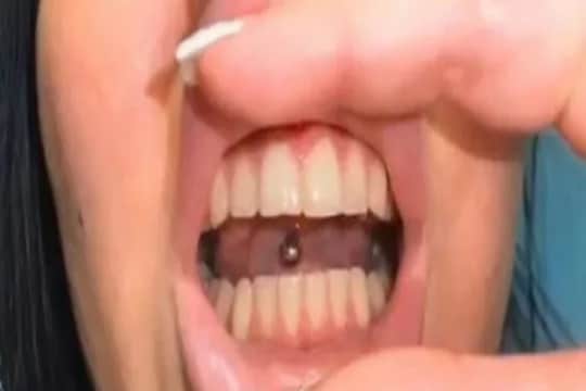 घासून घासून महिलेने दातांची अक्षरशः लावली वाट; पाहून डेंटिस्टही झाले शॉक