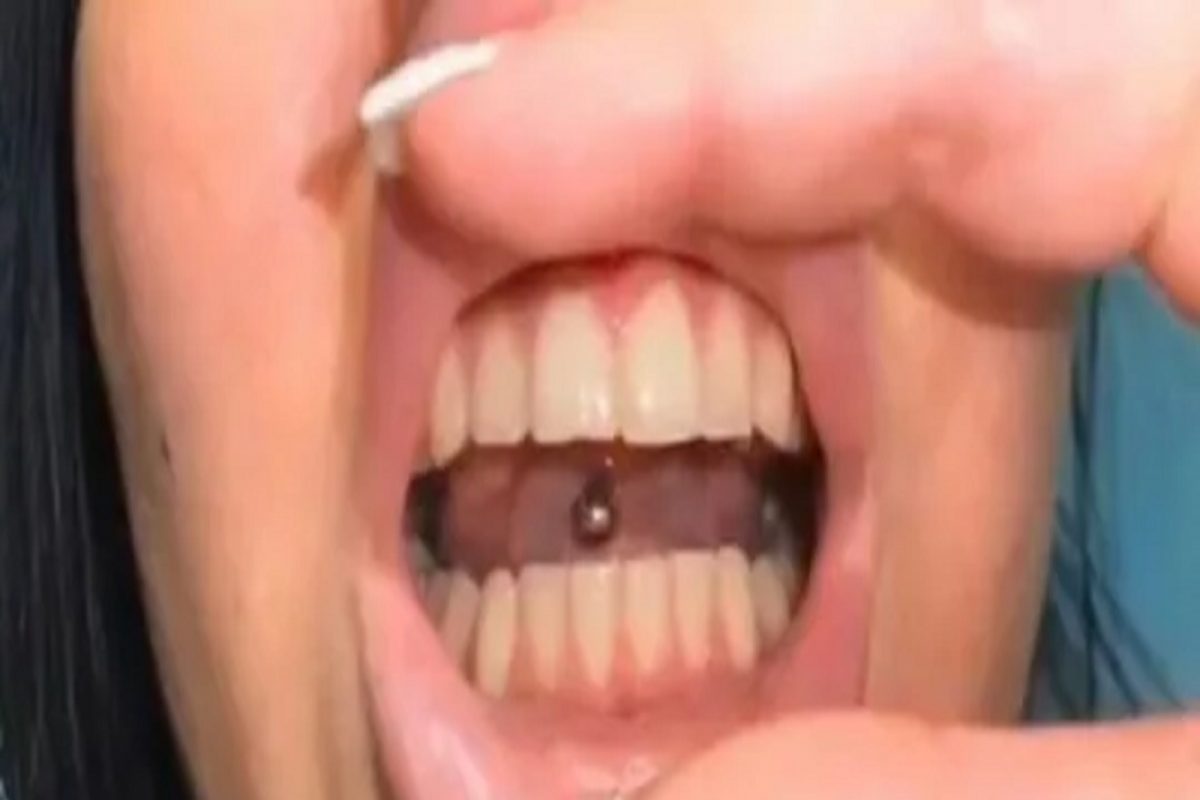 घासून घासून महिलेने दातांची अक्षरशः लावली वाट; पाहून डेंटिस्टही झाले शॉक