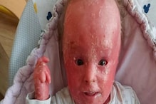विचित्र त्वचा असलेली Miracle baby; डॉक्टरांची मृत्यूची भविष्यवाणीही खोटी ठरवली विचित्र त्वचा असलेली Miracle baby; डॉक्टरांची मृत्यूची भविष्यवाणीही खोटी ठरवली
