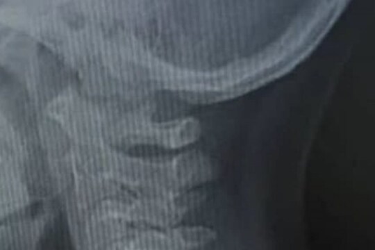 7 वर्षाच्या मुलाला अचानक होऊ लागला श्वास घेण्यास त्रास; X-ray रिपोर्टमधून धक्कादायक खुलासा