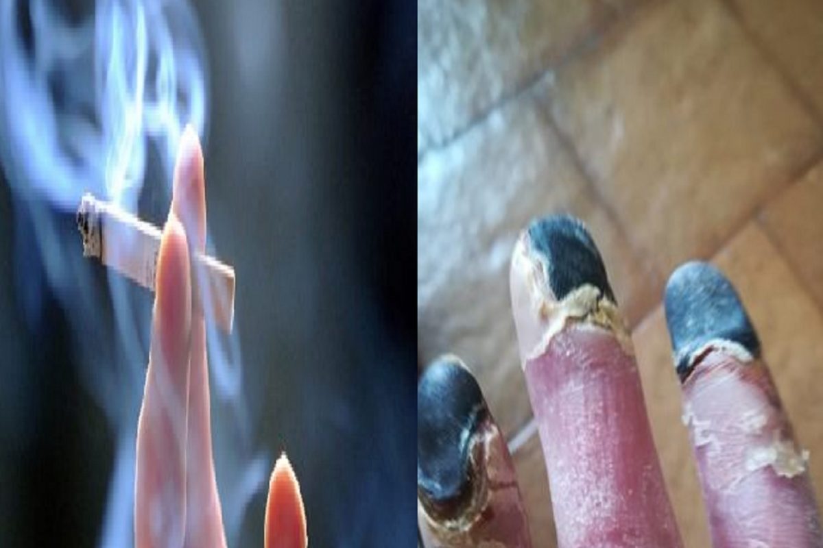 Smoking side effect : फुंकून फुंकून सडून गळू लागली महिलेच्या हाताची बोटं; स्मोकिंगचा भयंकर परिणाम