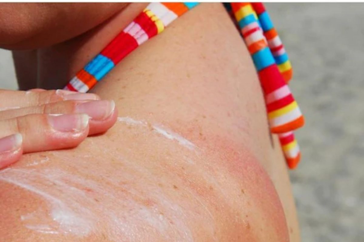 उन्हाळ्यात जाणवू शकतो सनपॉयझनिंगचा त्रास, जाणून घ्या लक्षणं आणि बचाव