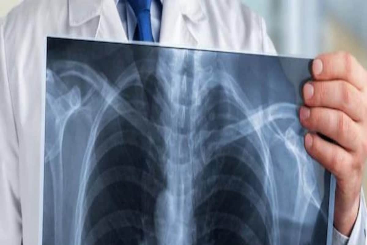 हॉस्पिटलनं दोन दिवसांच्या उपचारासाठी रुग्णाकडून आकारले 52 लाख रुपये, नंतर झुगाड करत स्वतः बनवले एक्स-रे मशीन