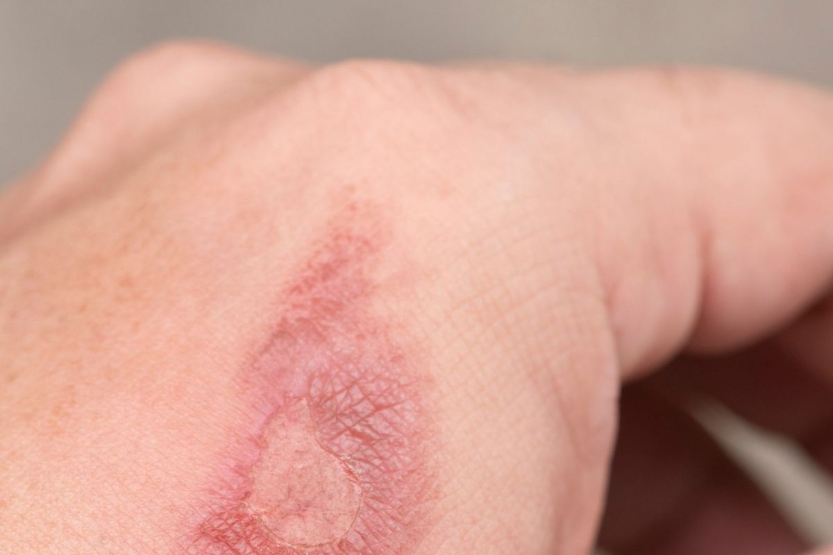 Burning Tips: हात भाजल्यावर अनेकजण या चुका करतात; जखम त्यामुळं लवकर बरी नाही होत