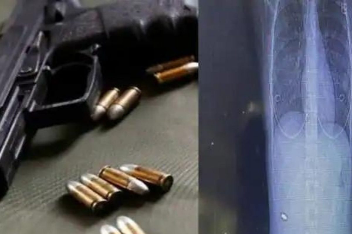 15 वर्षांपासून महिलेच्या पाठीमध्ये अडकलेली बंदुकीची गोळी; अखेर दीड दशकानंतर झाला त्या घटनेचा खुलासा